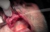 Suturing Technique - Implant Surgery, #5-6-7 Sites