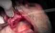 Suturing Technique - Implant Surgery, #5-6-7 Sites