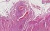 Small Intestine - Rheumatoid Vasculitis