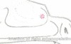 Epistaxis - Artery Ligation