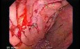 Consecutive colonoscopy with dilation was carried out (11 of 15)