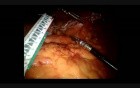 Longitudinal Sleeve Gastrectomy with Posterior Crural Repair