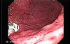 Acute Gastritis (Pangastritis) (8 of 10)