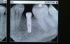 Narrow Diameter Implants
