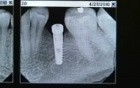 Narrow Diameter Implants