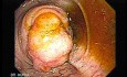 Colonoscopy - Adenocarcinoma Of The Cecum (1 of 4)