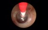 Brain tumor (Cyst) - Endoscopy