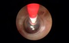 Brain tumor (Cyst) - Endoscopy