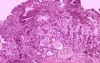 Gallbladder Adenocarcinoma and litiasis (11 of 13)