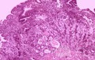 Gallbladder Adenocarcinoma and litiasis (11 of 13)