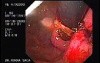Intraluminal Endoscopic Suturing - Endoscopic Assessment of the Gastric Fundus in the Final Stage of the Procedure