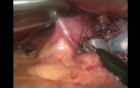 Adjustable gastric band removal - laparoscopic method