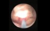Extracorporal Shock Wave Lithotripsy - Steinstrasse