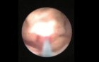 Extracorporal Shock Wave Lithotripsy - Steinstrasse