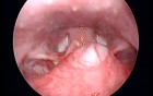 Tongue base mass with prominent overlying vessels