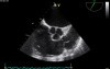 Transesophageal Echocardiography,  Observation of Pulmonary Valve