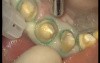 Finishing Preparations - Prosthetic Rehabilitation (2/3)