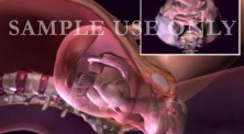 Childbirth - Normal Vaginal Delivery 