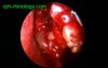 Double Uncinate Process Of Ethmoid Bone