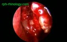 Double Uncinate Process Of Ethmoid Bone