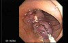 Stalked Polyp - Polypectomy (3 of 6)