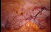 Colonic Perforation With Peritonitis - Laparoscopy (21 of 46)