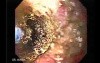 Adenocarcinoma of the Gastroesophageal Junction - Recanalization of the Lumen by Use of Balloon Dilation and Argon Plasma Coagulator