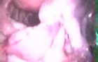 Laparoscopic Treatment Of Adnexal Torsion
