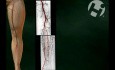 Compartment Syndrome