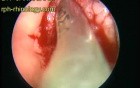 Laryngeal Papillomatosis