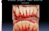 How To Aplicate Emdogain (Part 3)