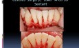 How To Aplicate Emdogain (Part 3)