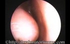 Chronic Sinusitis As Predisposing Factor To Middle Ear Effusion Formation