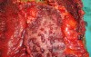 Multiple Rectal Ulcers (83 of 110)
