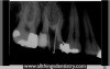 Endodontic Perforation - Hints To Help You When It Happens To You