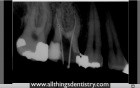 Endodontic Perforation - Hints To Help You When It Happens To You