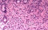 Endoscopy of Scirrhous Gastric Carcinoma involving the entire Fundus, Body and the Antrum (5 of 47)