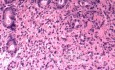 Endoscopy of Scirrhous Gastric Carcinoma involving the entire Fundus, Body and the Antrum (5 of 47)