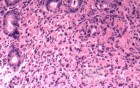 Endoscopy of Scirrhous Gastric Carcinoma involving the entire Fundus, Body and the Antrum (5 of 47)