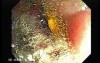 Dental Prothesis Found in the Jejuno (5 of 9)
