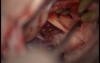 Glossopharyngeal Schwannoma - Right-Retrosigmoid Approach