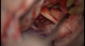 Glossopharyngeal Schwannoma - Right-Retrosigmoid Approach