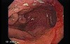 Primary Gastric Lymphoma Following Kidney Transplantation - Closer Look at the Mucosa