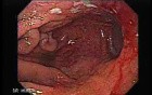Primary Gastric Lymphoma Following Kidney Transplantation - Closer Look at the Mucosa