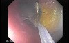Colonoscopic Polypectomy (13 of 29)