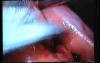 Jejunal Gastrointestinal Stromal tumor (GIST) (71 of 86)