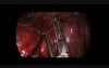 Situs Inversus Uniportal Thoracoscopic Left Middle Lobectomy 