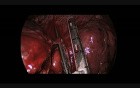 Situs Inversus Uniportal Thoracoscopic Left Middle Lobectomy 
