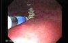 Watermelon Stomach (2 of 7) - Treatment with Argon Plasma Coagulator (APC)