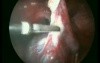 Surgery of Ovarian Cyst - Laparoscopic Method